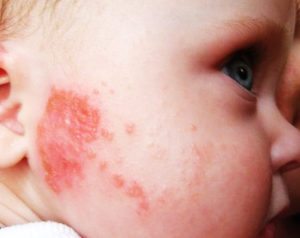 les allergies de l'enfant